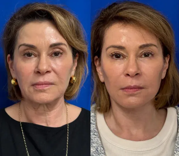 Front View Facelift and Eyelid Surgery before and after by Faceology MD