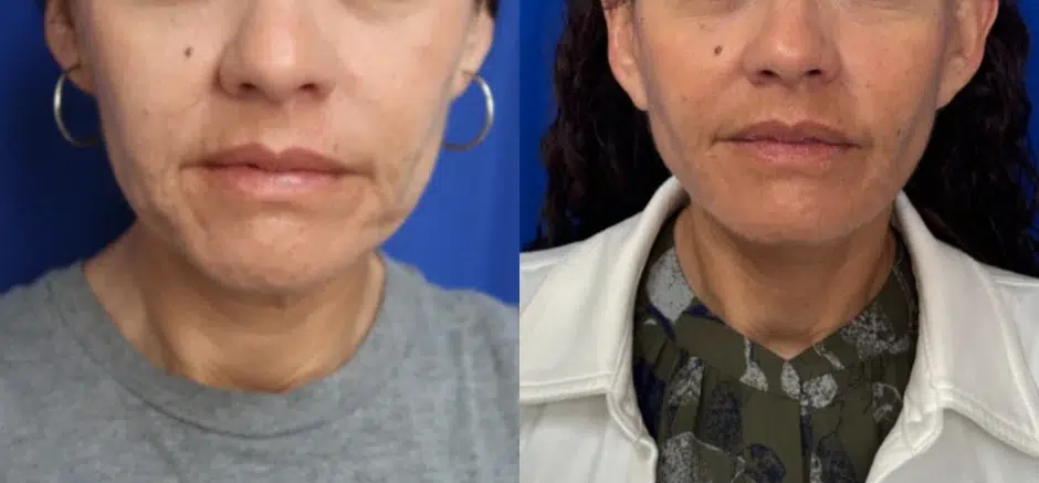 Front View Facelift before and after by Faceology MD