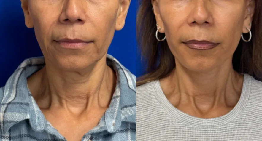 Front View Facelift before and after by Faceology MD