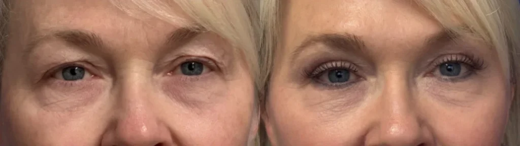 Front View Eyelid Surgey before and after by Faceology MD