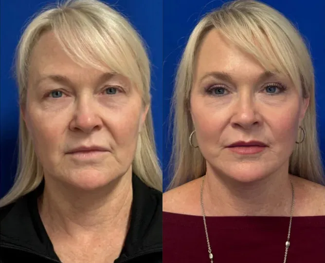 Front View Facelift and Upper Eyelid Surgery before and after by Faceology MD
