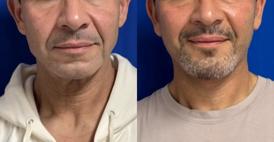 Front View Facelift before and after by Faceology MD